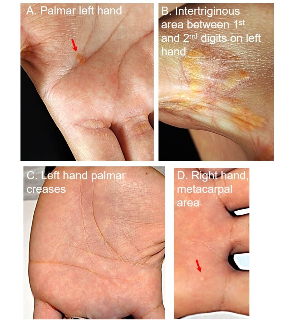 Four photos of the palms of the previously described patients, with patient A's palms depicted in the top two photos, and patient B's palms depicted in the bottom two.