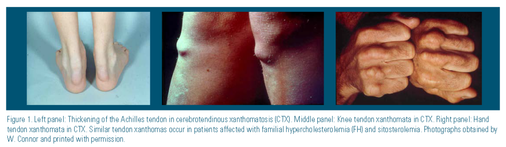 examples of tuberous and tendon xanthomas