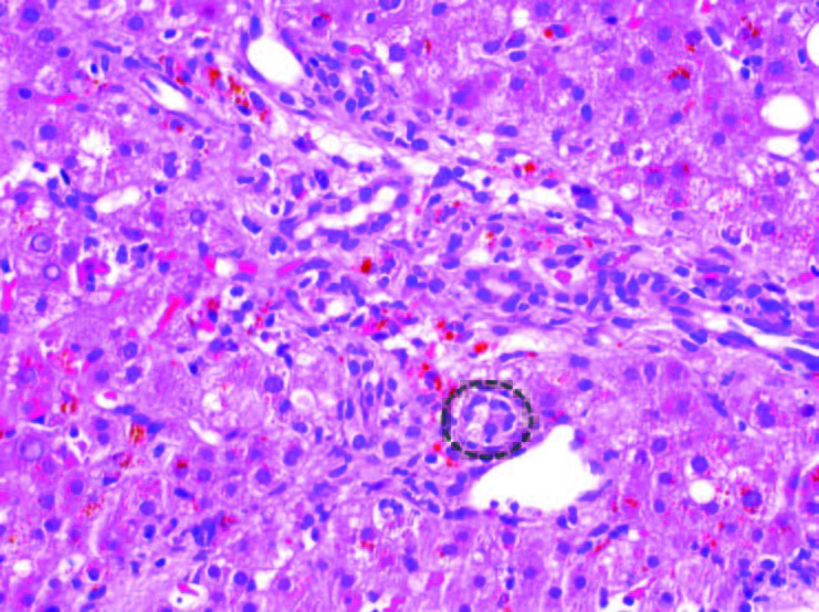 Figure 1. Liver, biopsy (200X magnification). Graft-versus-host disease. One of the injured bile ducts within this portal tract is highlighted by the black circle. The other bile ducts seen in this portal tract show similar features (see text for description).